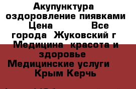 Акупунктура, оздоровление пиявками › Цена ­ 3 000 - Все города, Жуковский г. Медицина, красота и здоровье » Медицинские услуги   . Крым,Керчь